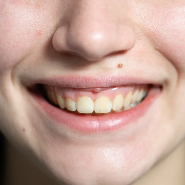 Immagine trattamento gummy smile - Prima