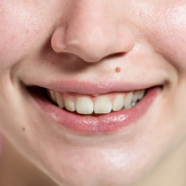 Immagine trattamento gummy smile - Dopo